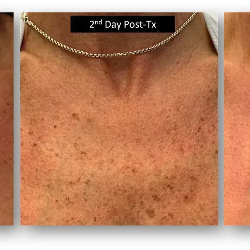 DermaV before and after result