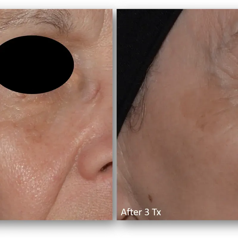 LaseMD Ultra before and after result 13
