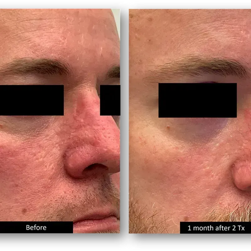 DermaV Laser before and after result 7