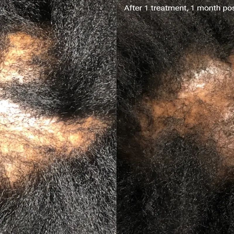 Hair loss before and after treatment - patient 2