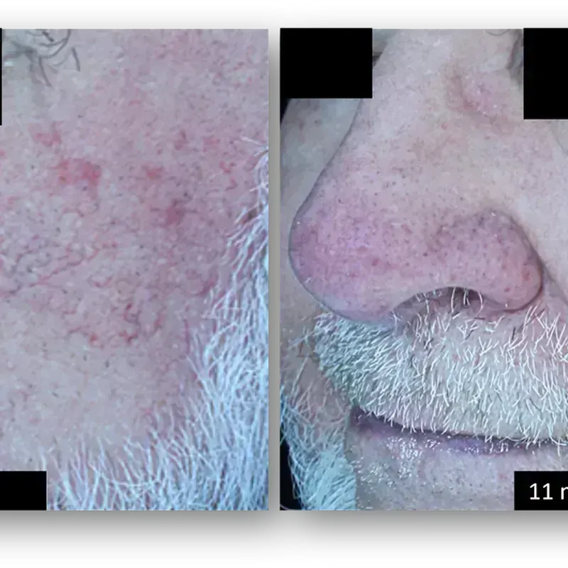 DermaV Laser before and after result 8