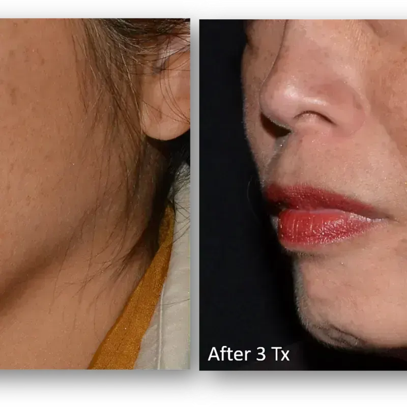 LaseMD Ultra before and after result 6