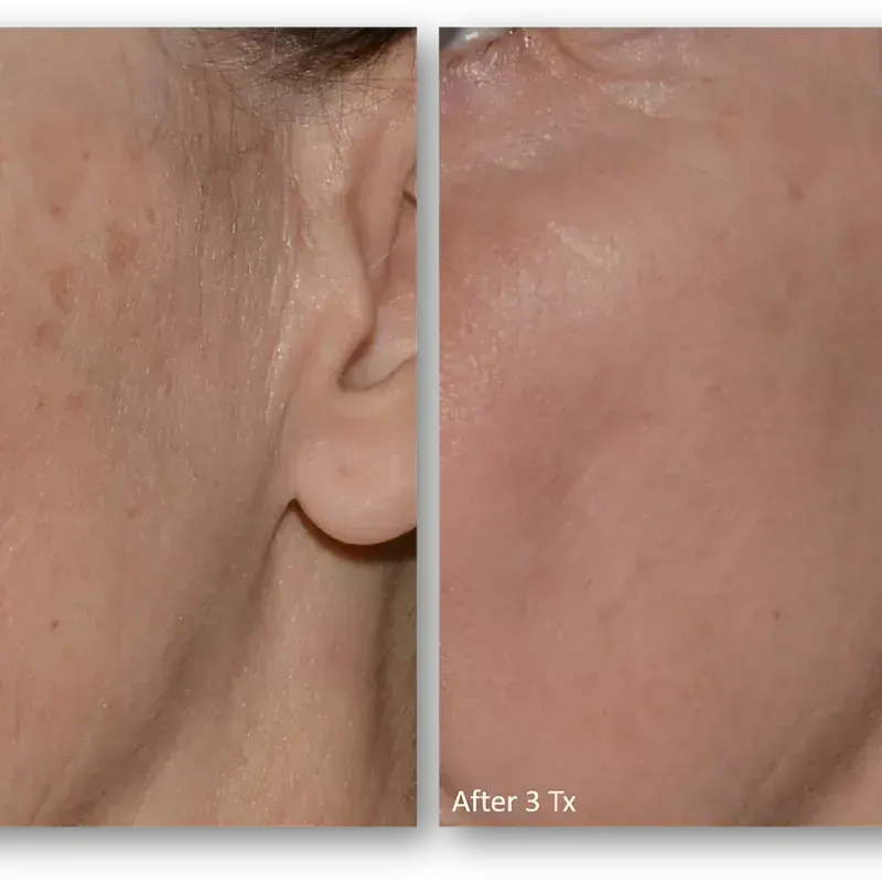 LaseMD Ultra before and after result 11