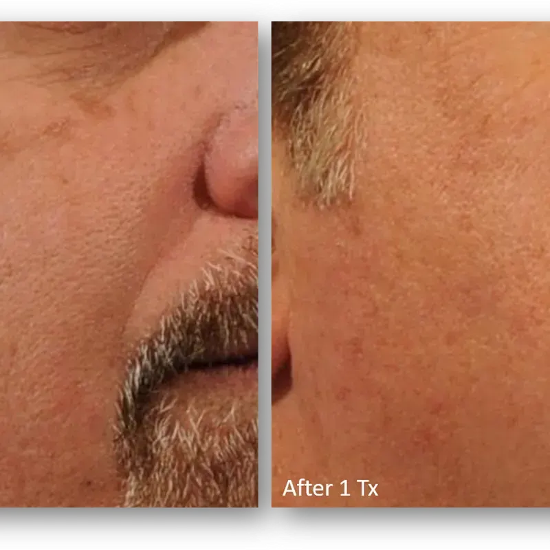 LaseMD Ultra before and after result