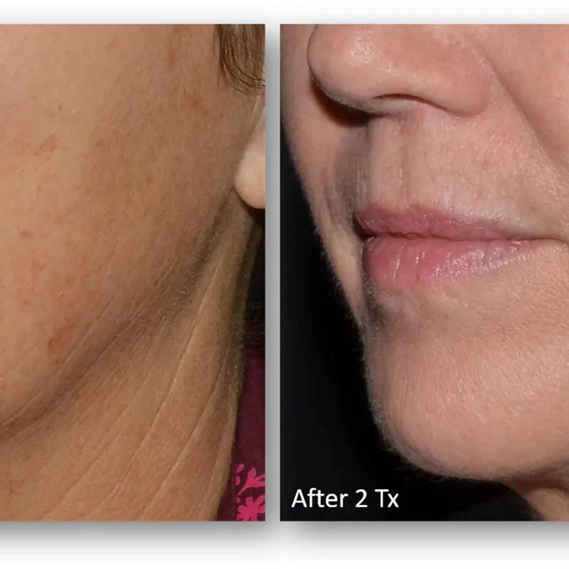 LaseMD Ultra before and after result 5
