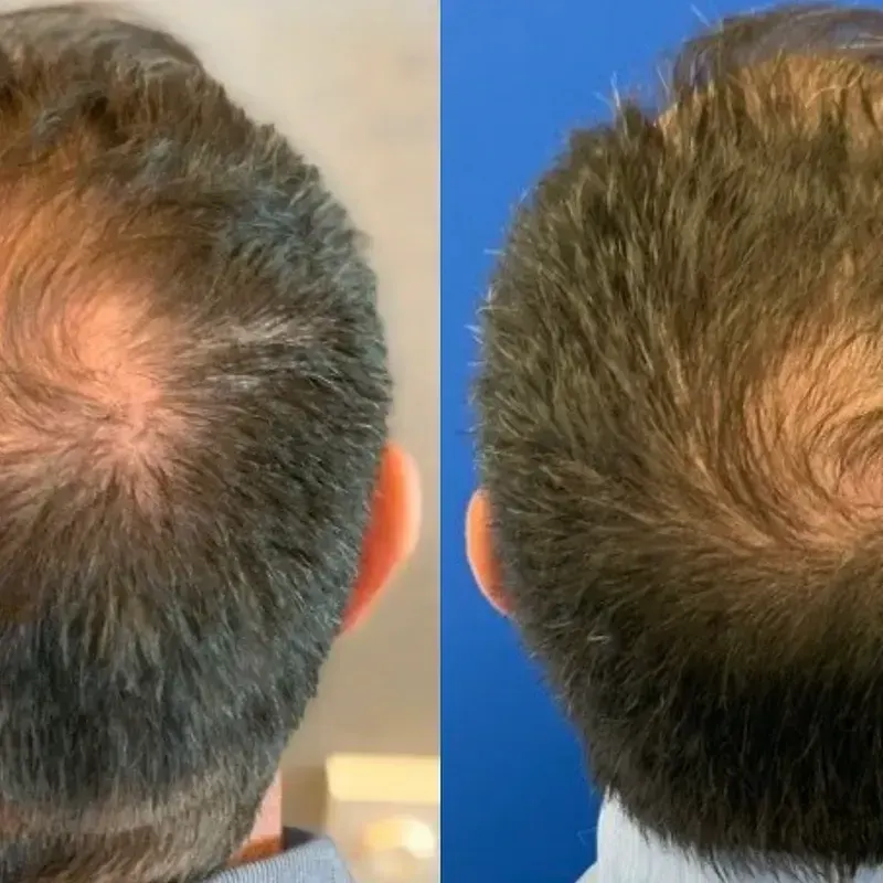 Hair Loss before and after result