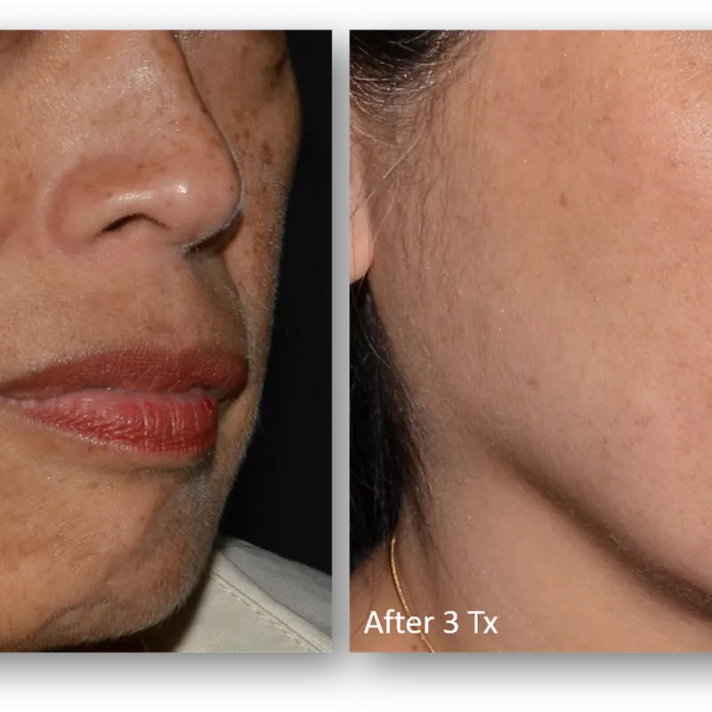 LaseMD Ultra before and after result 8