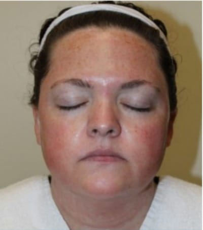 Microneedling 4 Hours After at Sergay Dermatology