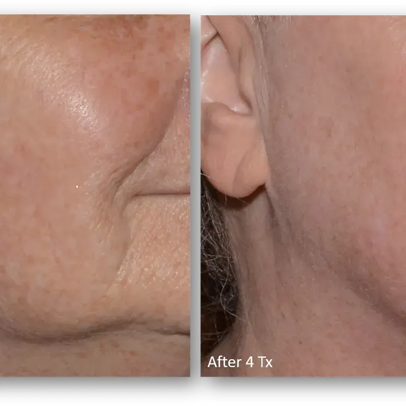 LaseMD Ultra before and after result 10