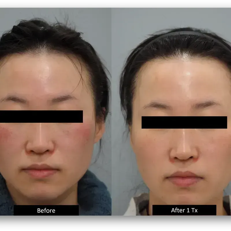 DermaV Laser before and after result 9